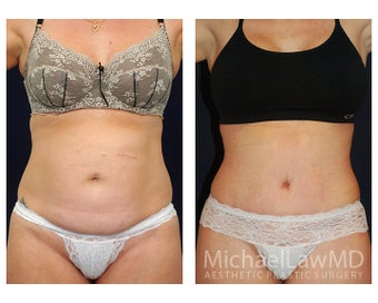 Abdominoplasty - Tummy Tuck