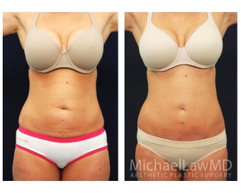 Abdominoplasty - Tummy Tuck