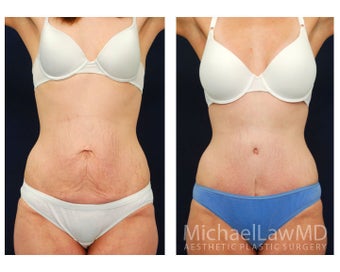 Abdominoplasty - Tummy Tuck