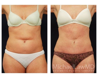 Abdominoplasty - Tummy Tuck