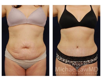 Abdominoplasty - Tummy Tuck