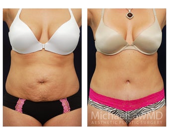 Abdominoplasty - Tummy Tuck