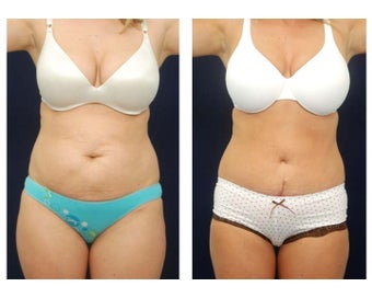 Abdominoplasty - Tummy Tuck