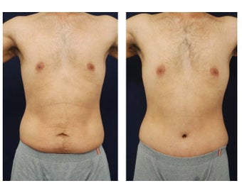 Abdominoplasty - Tummy Tuck