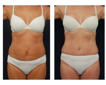 Abdominoplasty - Tummy Tuck