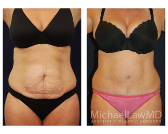 Abdominoplasty - Tummy Tuck