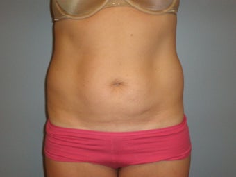 Mini Tummy Tuck 
