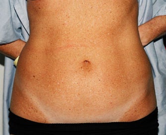 Mini-abdominoplasty