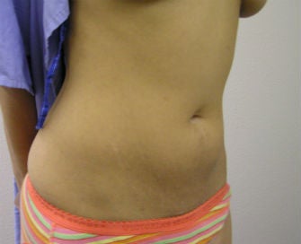Mini-abdominoplasty