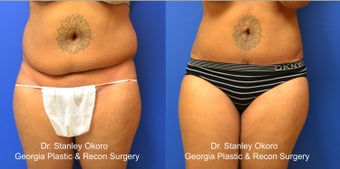 Mini Tummy Tuck
