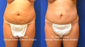 Mini Tummy Tuck