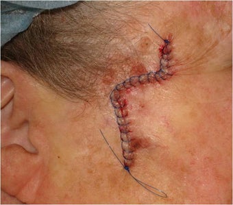 Closure of Mohs Surgery Defect