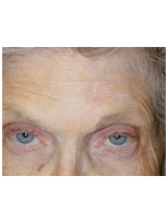 Skin cancer reconstruction