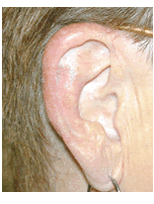 Skin cancer reconstruction on ear