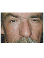 Sskin cancer reconstruction on the cheek