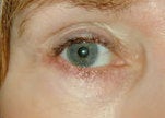 Eyelid skin cancer reconstruction
