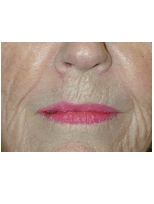 Lip skin cancer reconstruction