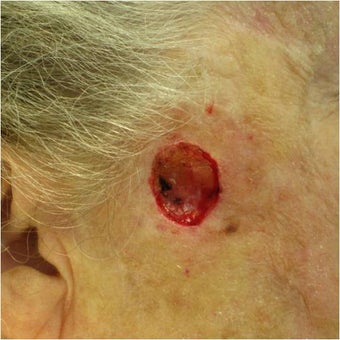 Closure of Mohs Surgery Defect