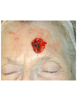 Skin cancer reconstruction