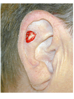 Skin cancer reconstruction on ear