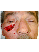 Sskin cancer reconstruction on the cheek