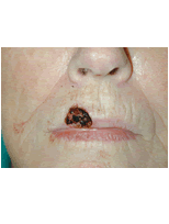 Lip skin cancer reconstruction