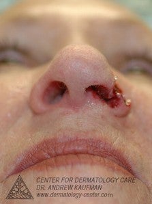 Mohs Surgery of Basal Cell Carcinoma and Recontruction