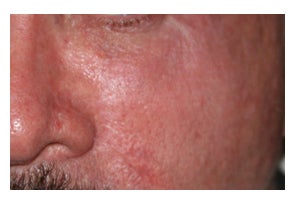 Mohs Surgery