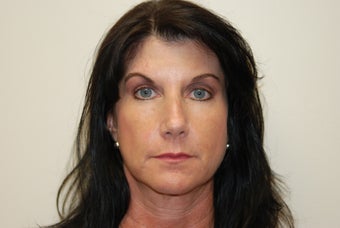 Forehead reconstruction after MOHS surgery and Left Brow Lift For Symmetry