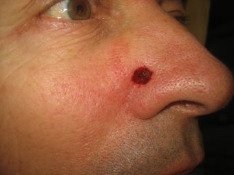 Mohs Surgery