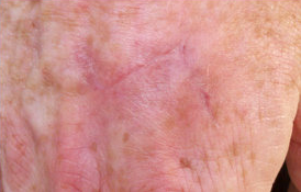 Skin Cancer Surgery on Hand
