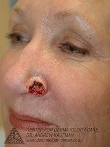Mohs Surgery of Basal Cell Carcinoma and Recontruction