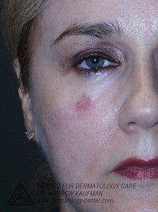 Mohs Surgery of Lentigo Maligna (Melanoma) and Reconstruction