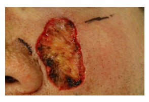Mohs Surgery