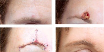 MOHS Skin Cancer Surgery