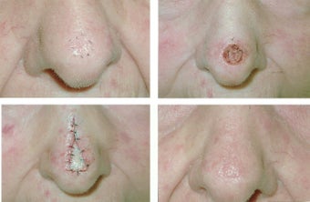 MOHS Skin Cancer Surgery