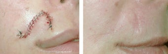 MOHS Skin Cancer Surgery