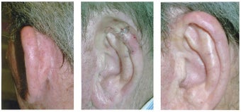 MOHS Skin Cancer Surgery