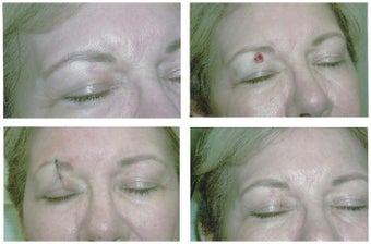 MOHS Skin Cancer Surgery