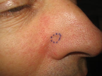 Mohs Surgery