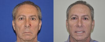 Skin Cancer Reconstruction of the Nose