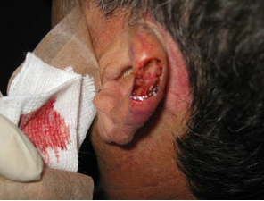 Skin Cancer Surgery on Ear