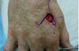 Skin Cancer Surgery on Hand