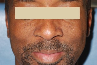 Removing facial moles