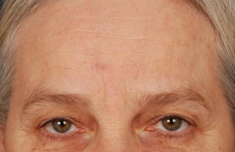 Mole Removal