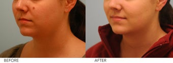 Mole Removal