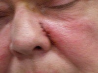 Basal Cell Carcinomas Excisions