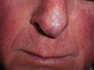 Basal Cell Carcinomas Excisions