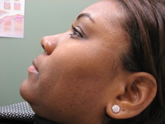 DPN removal