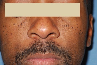 Removing facial moles
